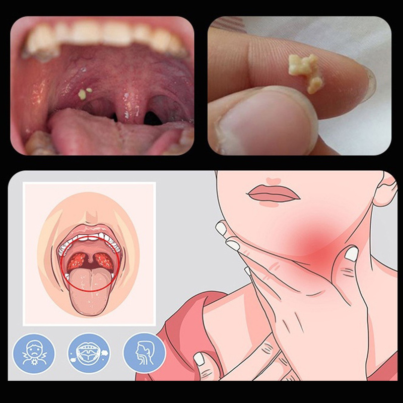 ~귀지 토니실 결석 제거 도구 LED 조명 스테인레스  - Ear Wax Remover 리뷰 및 가격